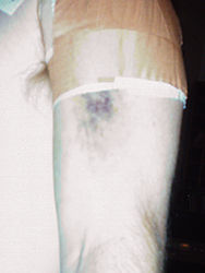 Photo of the outside of Hughie's left arm showing the blueberry muffin bruise on his bicep